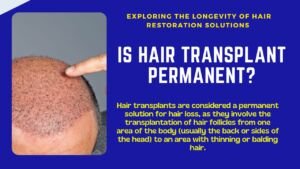 Is Hair Transplant Permanent?