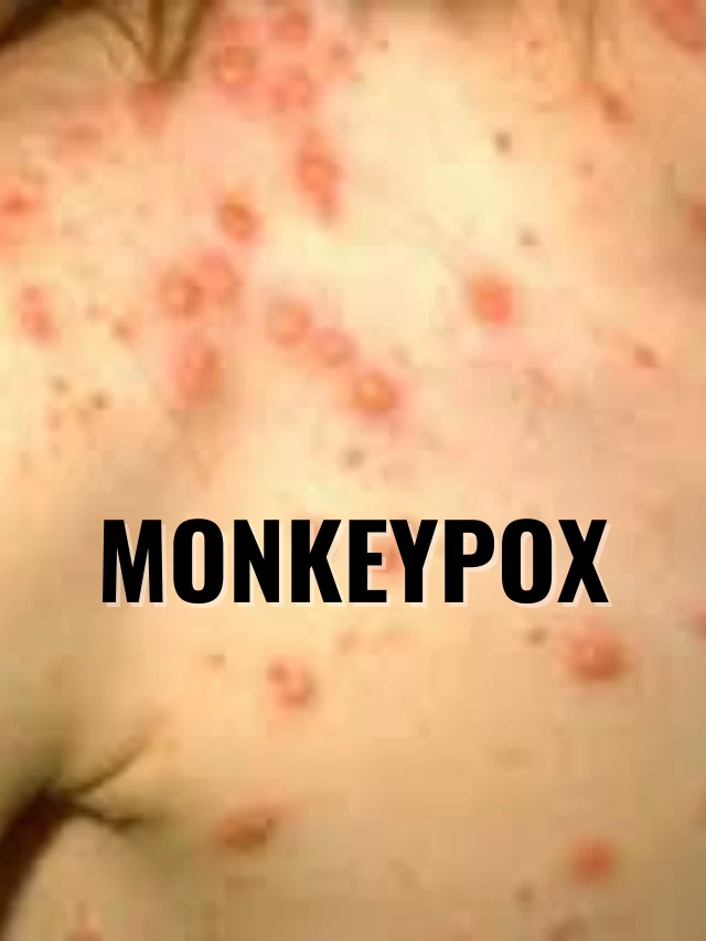 Monkeypox, Symptomps and Prevention