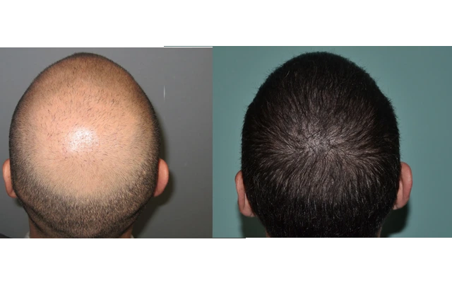 Hair Transplant Prices in Indore