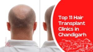 Hair Transplant Clinics in Chandigarh