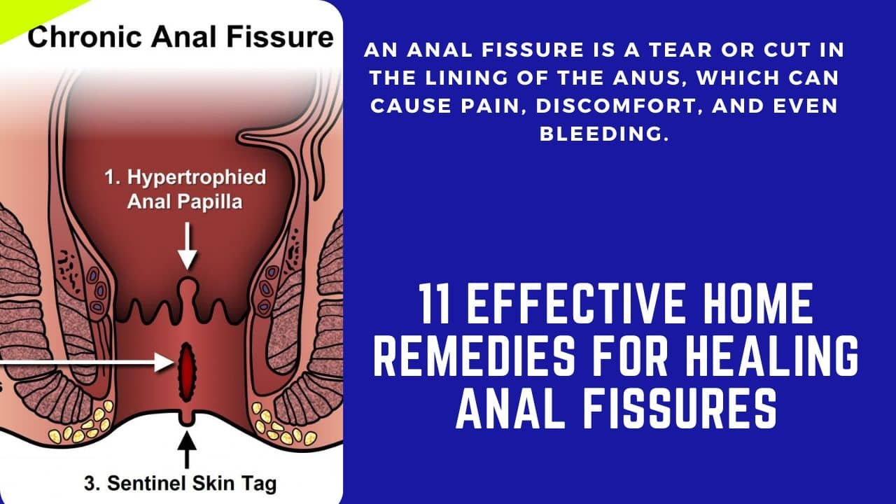 Home Remedies for Healing Anal Fissures