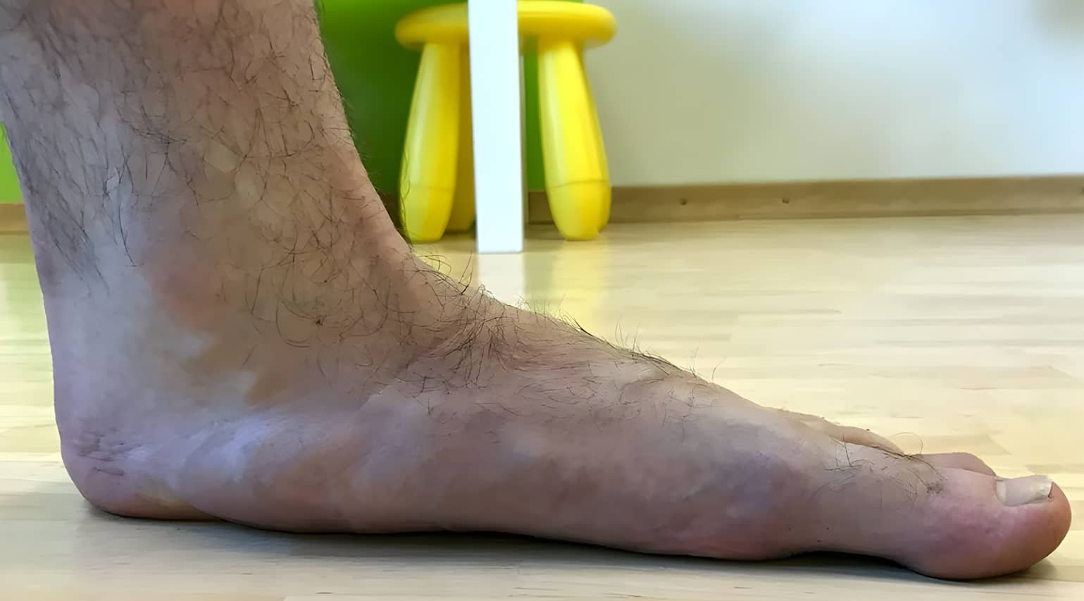 How to Treat Flat Feet